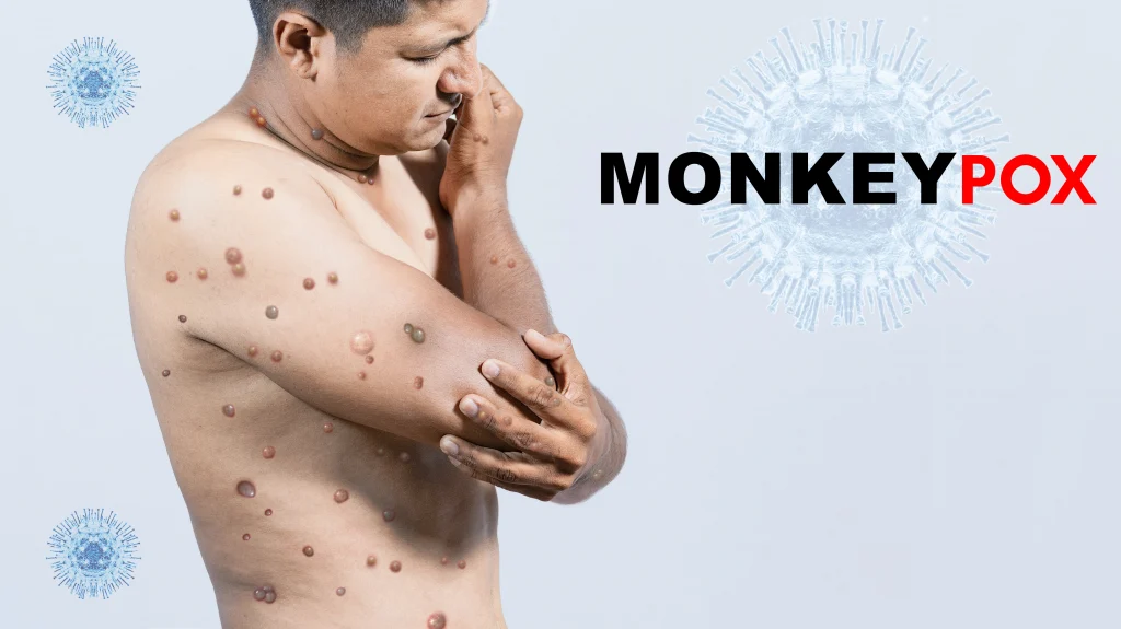 A wider picture of monkeypox